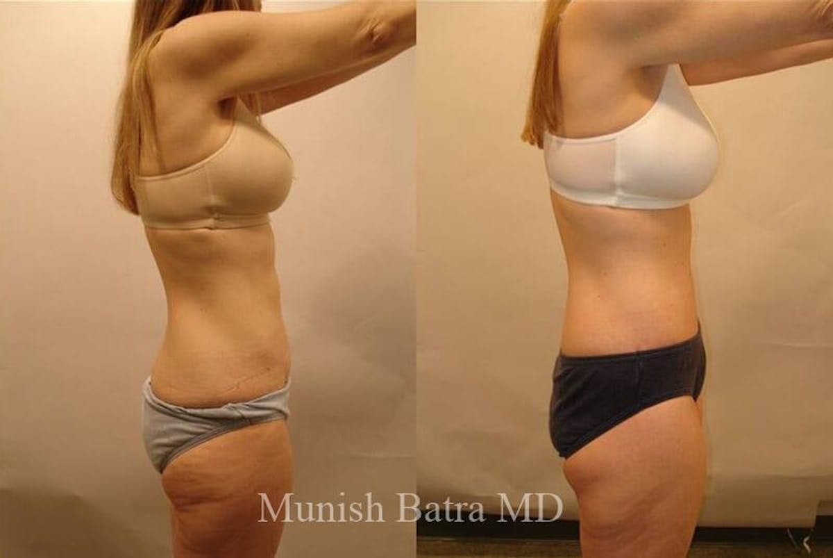 GBRX Abdominoplasty Reconstruction Before & After Gallery - Patient 362590 - Image 2