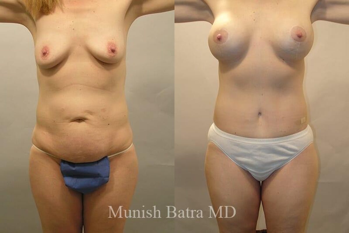 GBRX Abdominoplasty Reconstruction Before & After Gallery - Patient 109664 - Image 1