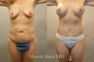 GBRX Abdominoplasty Reconstruction Before & After Gallery - Patient 109664 - Image 1