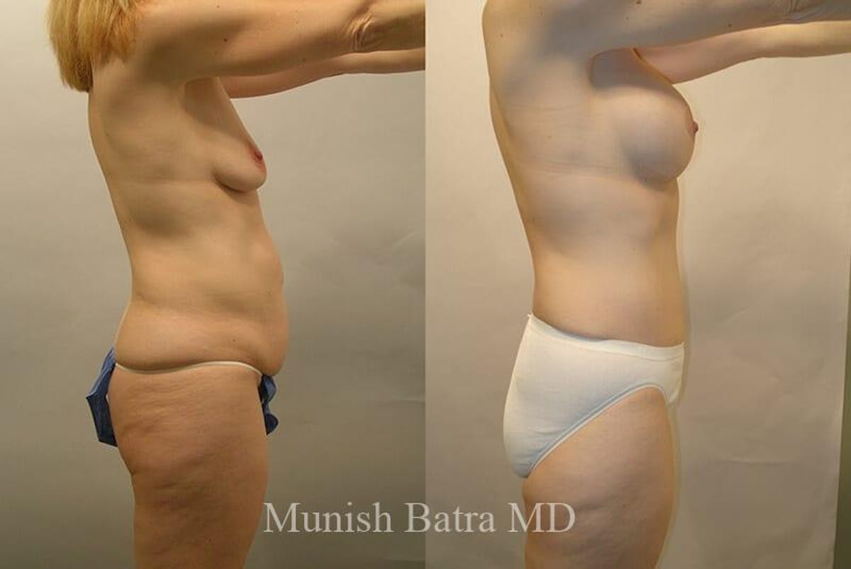 GBRX Abdominoplasty Reconstruction Before & After Gallery - Patient 109664 - Image 2
