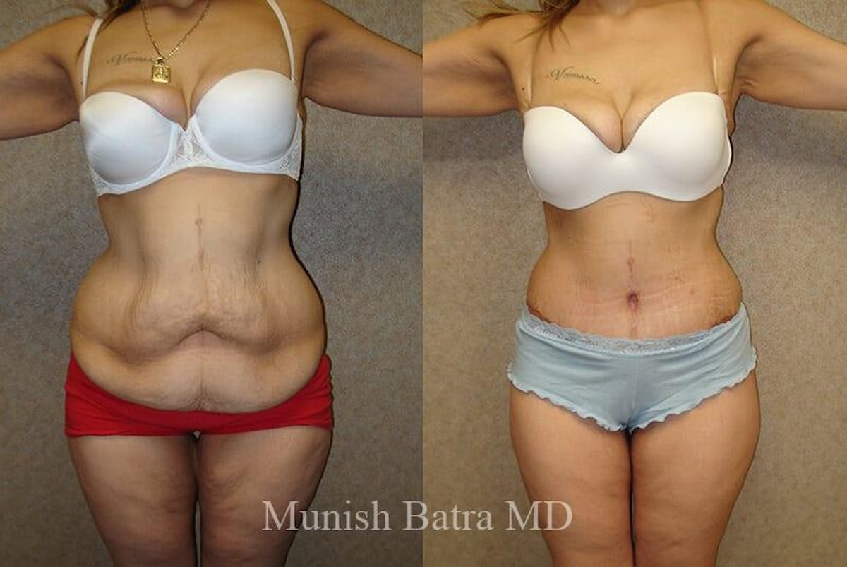 GBRX Abdominoplasty Reconstruction Before & After Gallery - Patient 652682 - Image 1