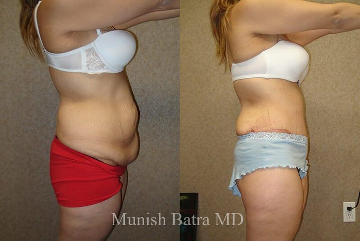 GBRX Abdominoplasty Reconstruction Before & After Gallery - Patient 652682 - Image 2