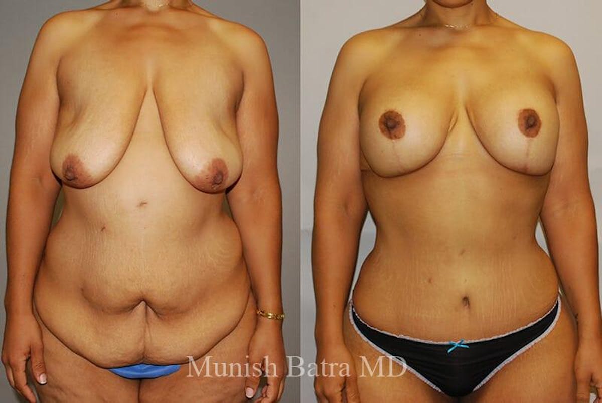 GBRX Abdominoplasty Reconstruction Before & After Gallery - Patient 433640 - Image 1