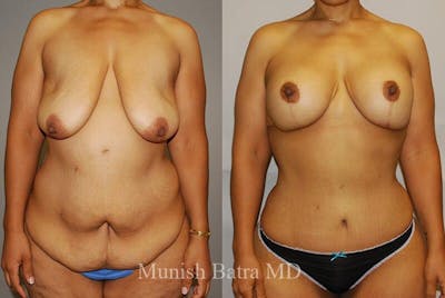 GBRX Abdominoplasty Reconstruction Before & After Gallery - Patient 433640 - Image 1