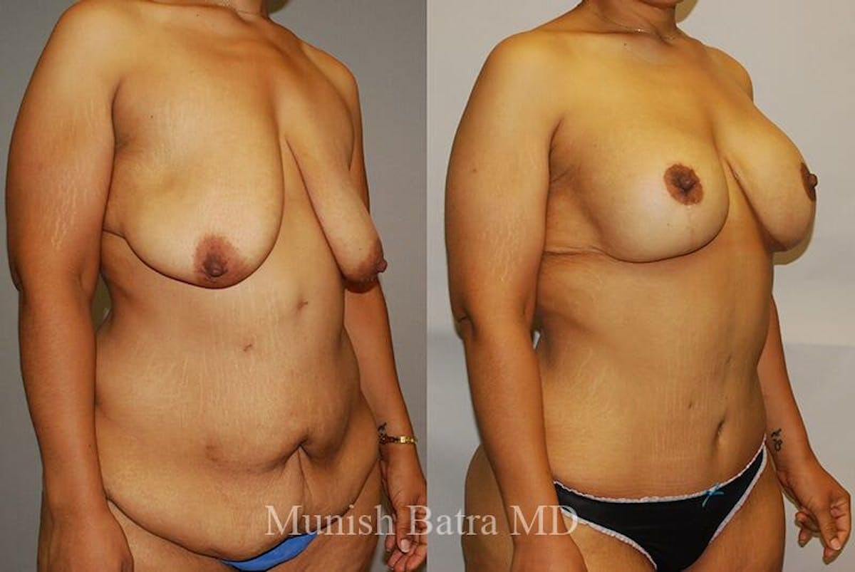GBRX Abdominoplasty Reconstruction Before & After Gallery - Patient 433640 - Image 2
