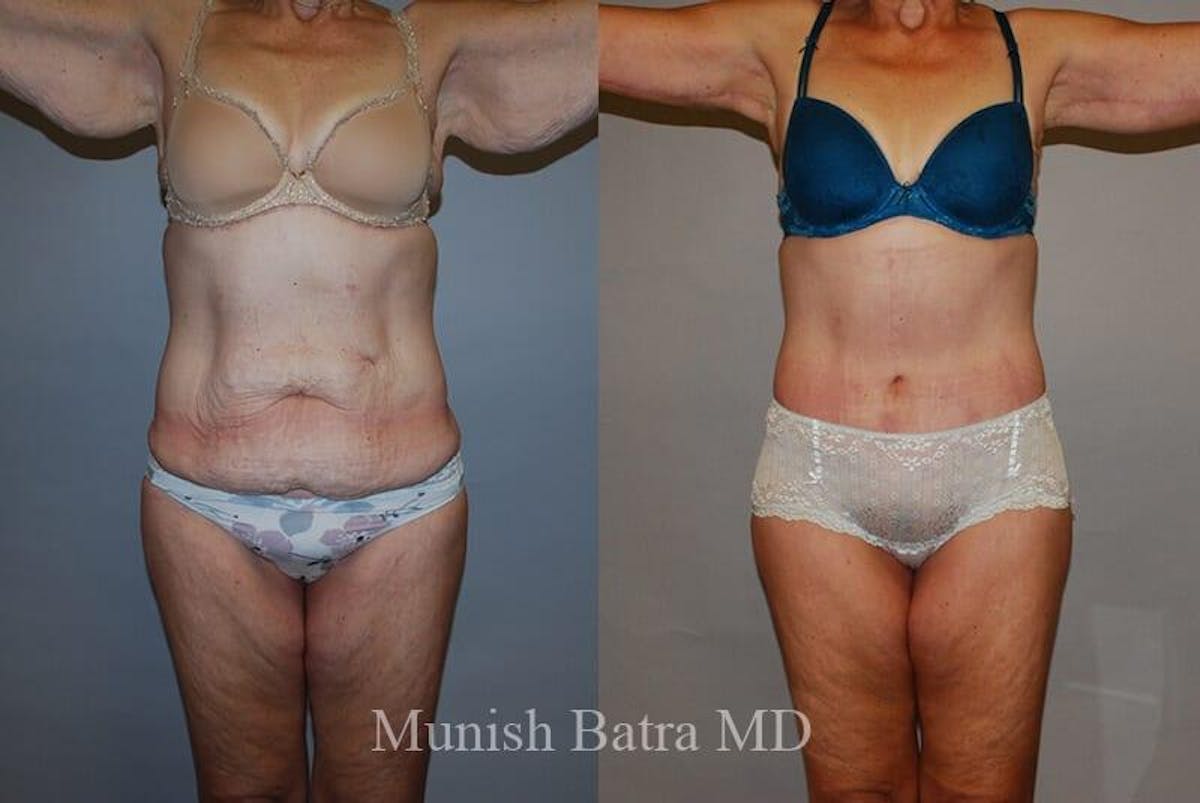 GBRX Abdominoplasty Reconstruction Before & After Gallery - Patient 294731 - Image 1