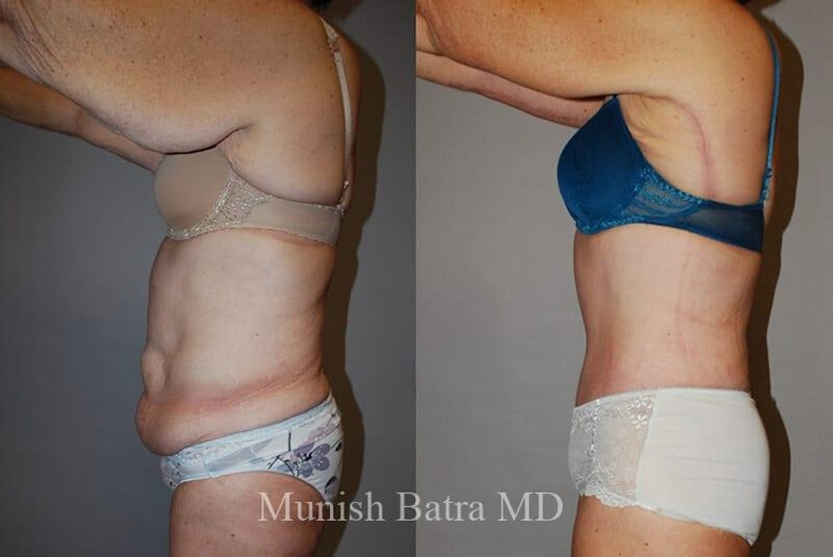 GBRX Abdominoplasty Reconstruction Before & After Gallery - Patient 294731 - Image 2