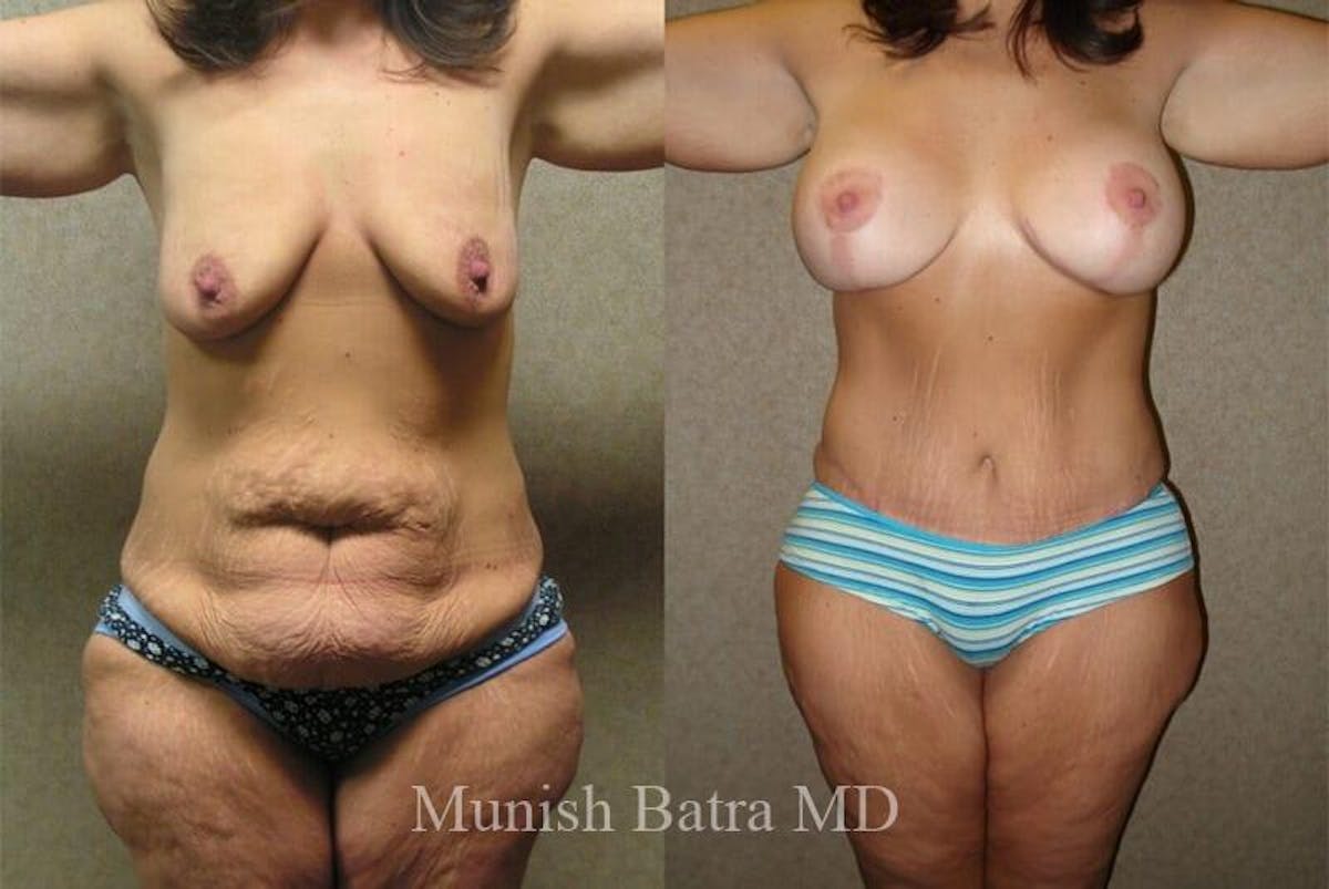 GBRX Abdominoplasty Reconstruction Before & After Gallery - Patient 676614 - Image 1
