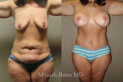 GBRX Abdominoplasty Reconstruction Before & After Gallery - Patient 676614 - Image 1