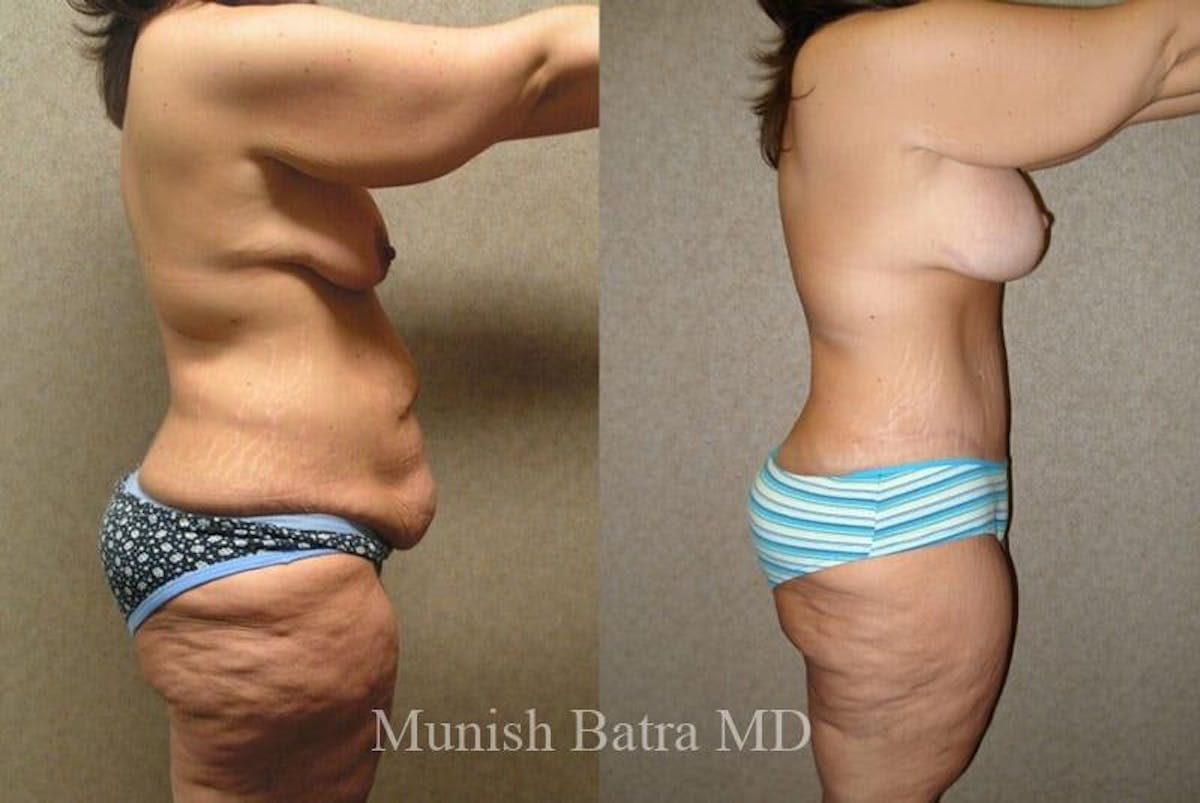 GBRX Abdominoplasty Reconstruction Before & After Gallery - Patient 676614 - Image 2