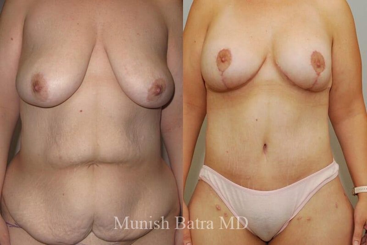 GBRX Abdominoplasty Reconstruction Before & After Gallery - Patient 215951 - Image 1