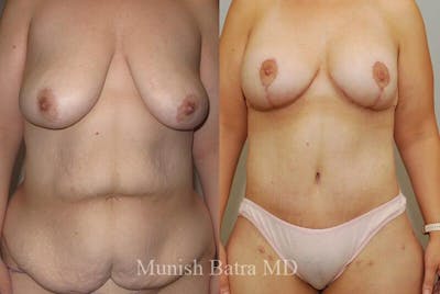 GBRX Abdominoplasty Reconstruction Before & After Gallery - Patient 215951 - Image 1