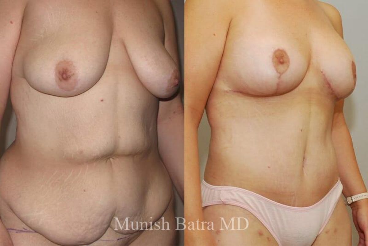 GBRX Abdominoplasty Reconstruction Before & After Gallery - Patient 215951 - Image 2