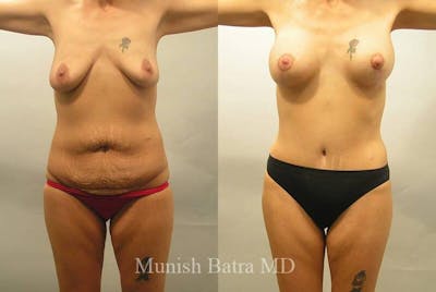 GBRX Abdominoplasty Reconstruction Before & After Gallery - Patient 973650 - Image 1