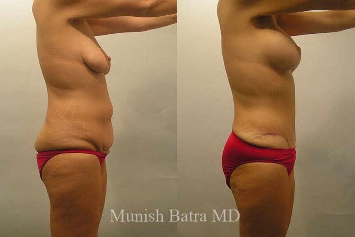 GBRX Abdominoplasty Reconstruction Before & After Gallery - Patient 973650 - Image 2