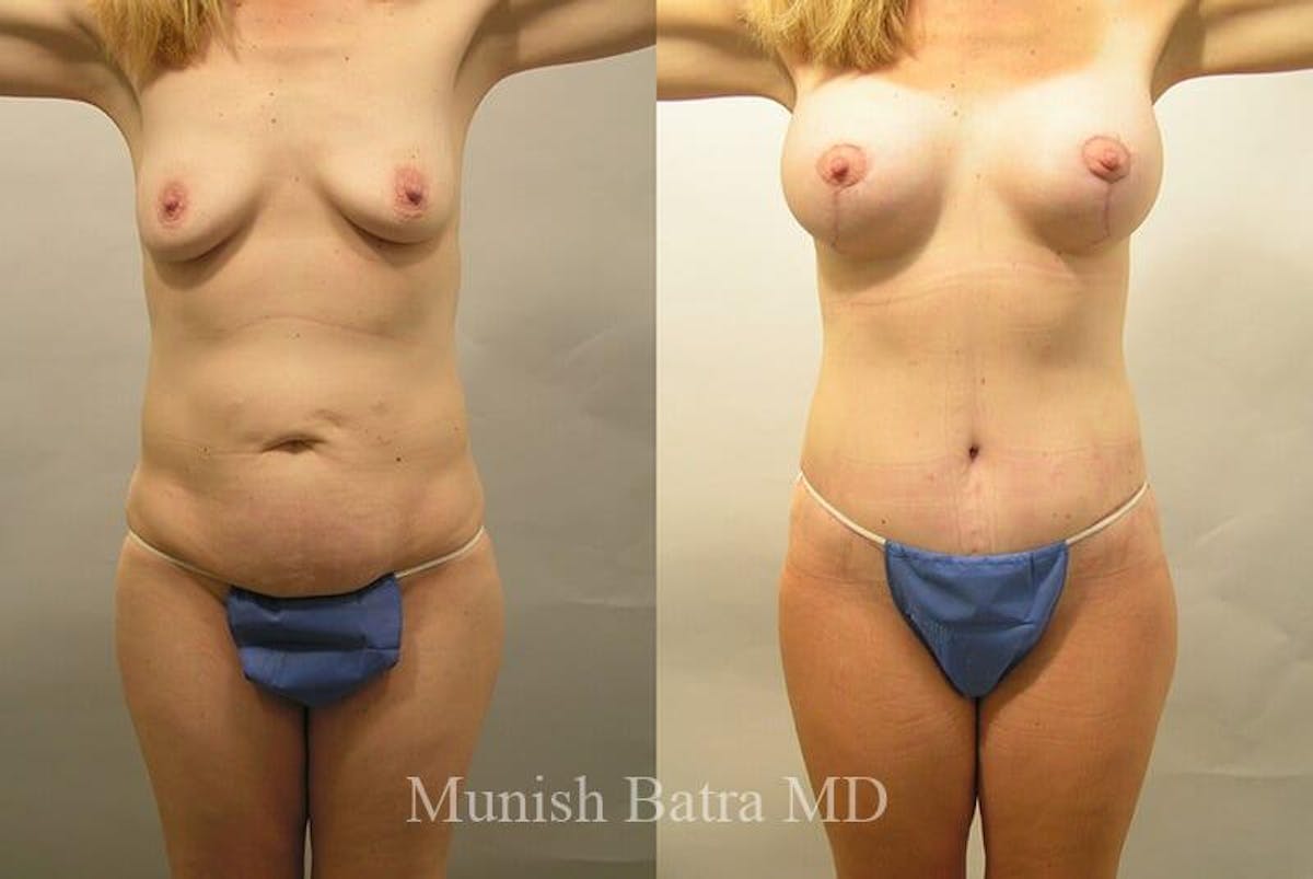 GBRX Abdominoplasty Reconstruction Before & After Gallery - Patient 663333 - Image 1