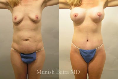 GBRX Abdominoplasty Reconstruction Before & After Gallery - Patient 663333 - Image 1