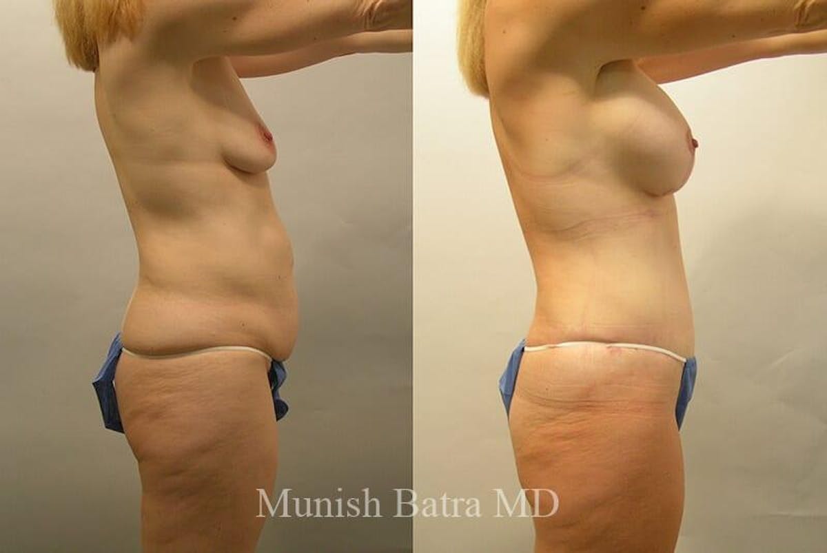 GBRX Abdominoplasty Reconstruction Before & After Gallery - Patient 663333 - Image 2