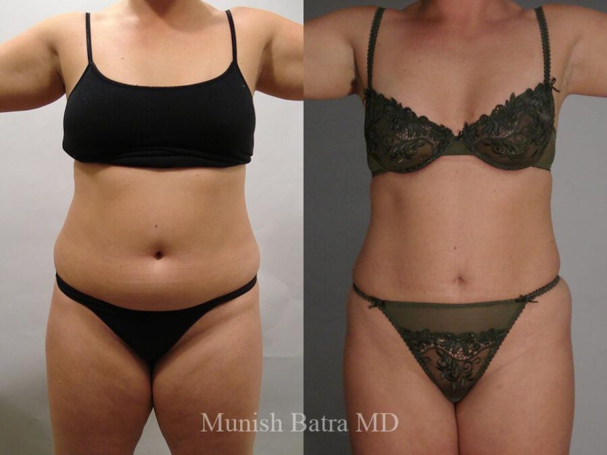 Liposuction & Body Contouring Before & After Gallery - Patient 353246 - Image 1
