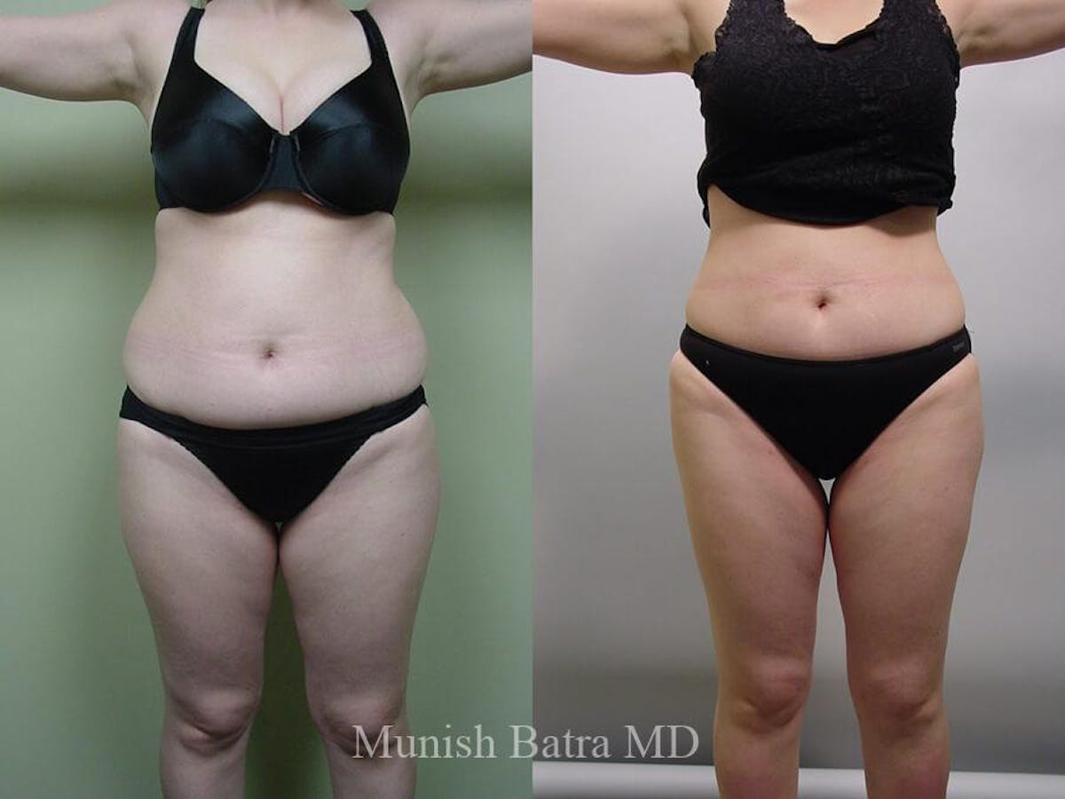 Liposuction & Body Contouring Before & After Gallery - Patient 613149 - Image 1