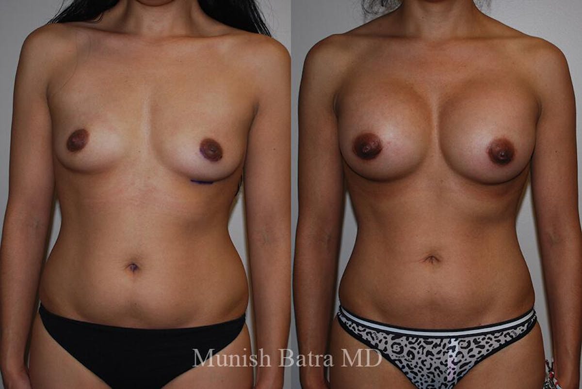 Liposuction & Body Contouring Before & After Gallery - Patient 884985 - Image 1