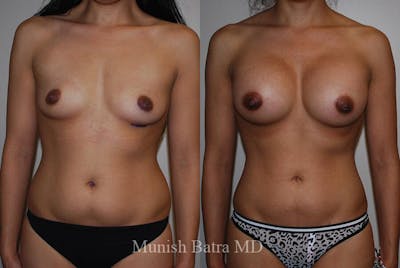 Liposuction & Body Contouring Before & After Gallery - Patient 125844 - Image 1