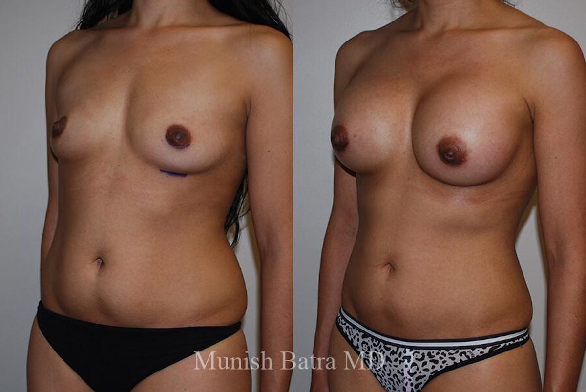 Liposuction & Body Contouring Before & After Gallery - Patient 884985 - Image 2