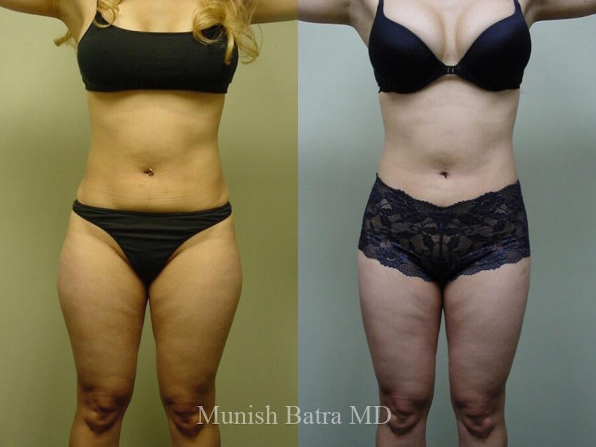 Liposuction & Body Contouring Before & After Gallery - Patient 180573 - Image 1
