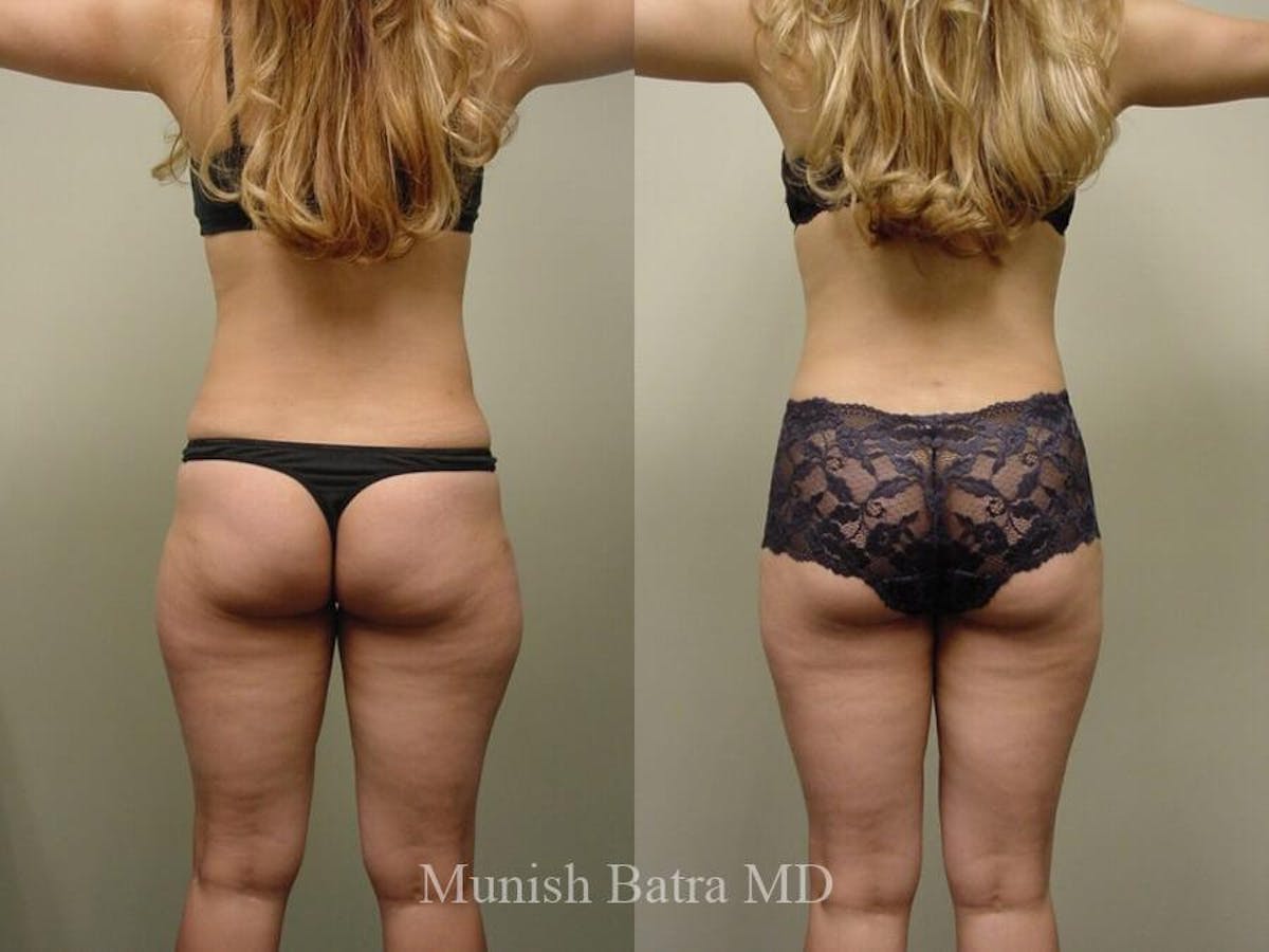 Liposuction & Body Contouring Before & After Gallery - Patient 180573 - Image 2