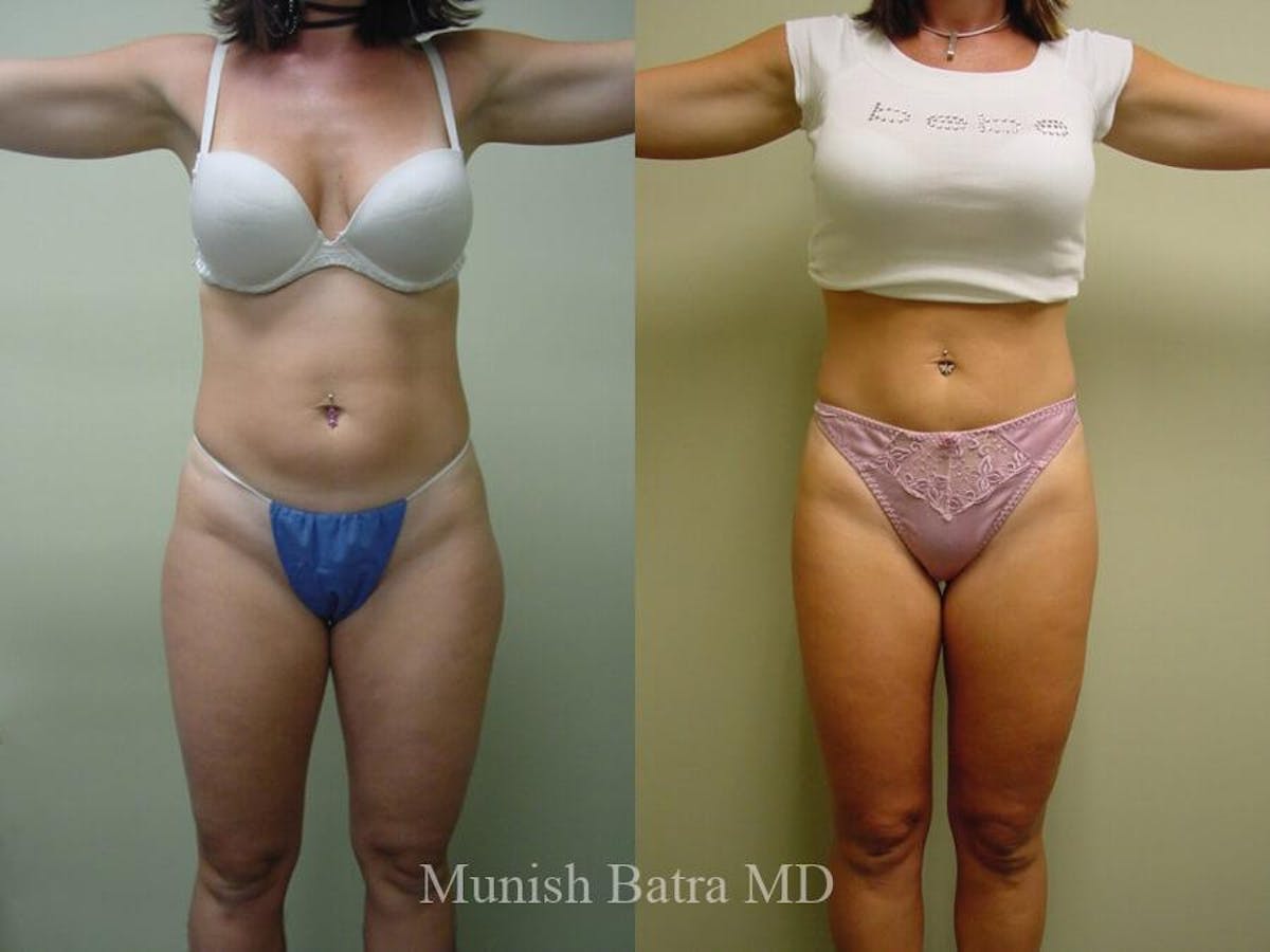 Liposuction & Body Contouring Before & After Gallery - Patient 427304 - Image 1