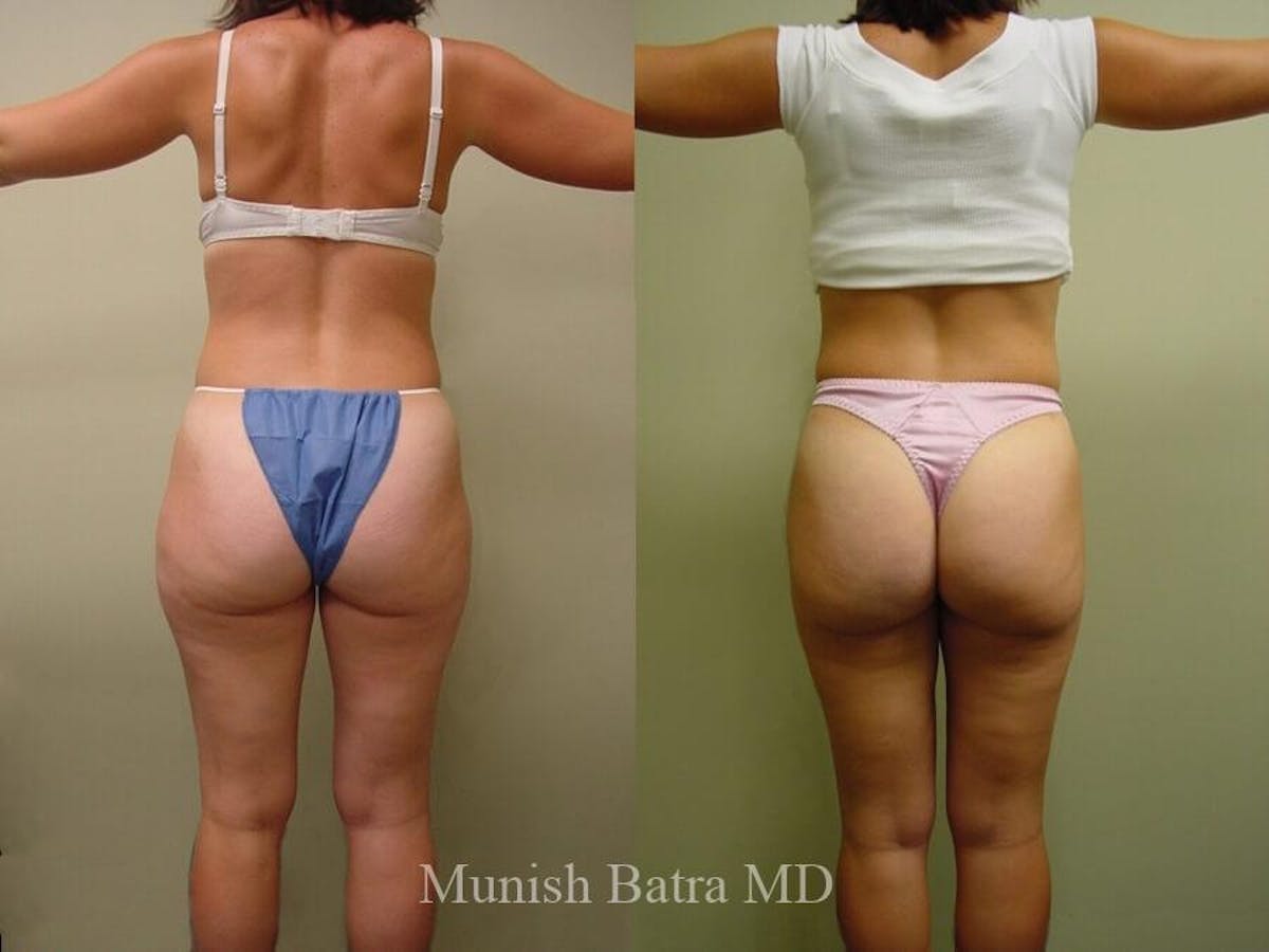 Liposuction & Body Contouring Before & After Gallery - Patient 427304 - Image 2