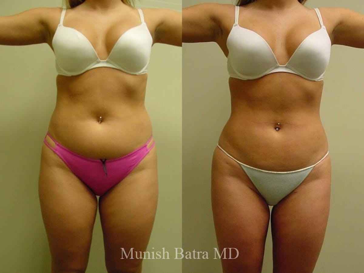 Liposuction & Body Contouring Before & After Gallery - Patient 271720 - Image 1