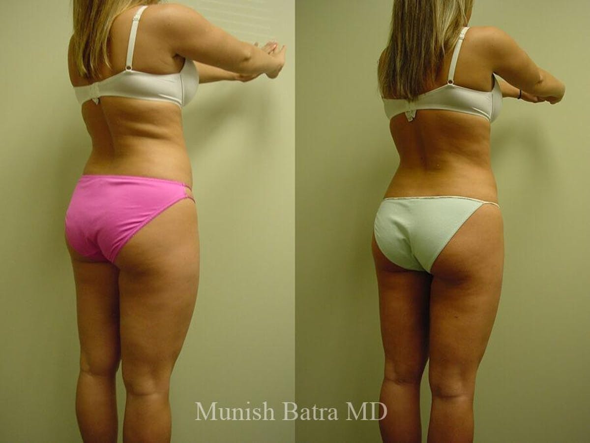 Liposuction & Body Contouring Before & After Gallery - Patient 271720 - Image 2