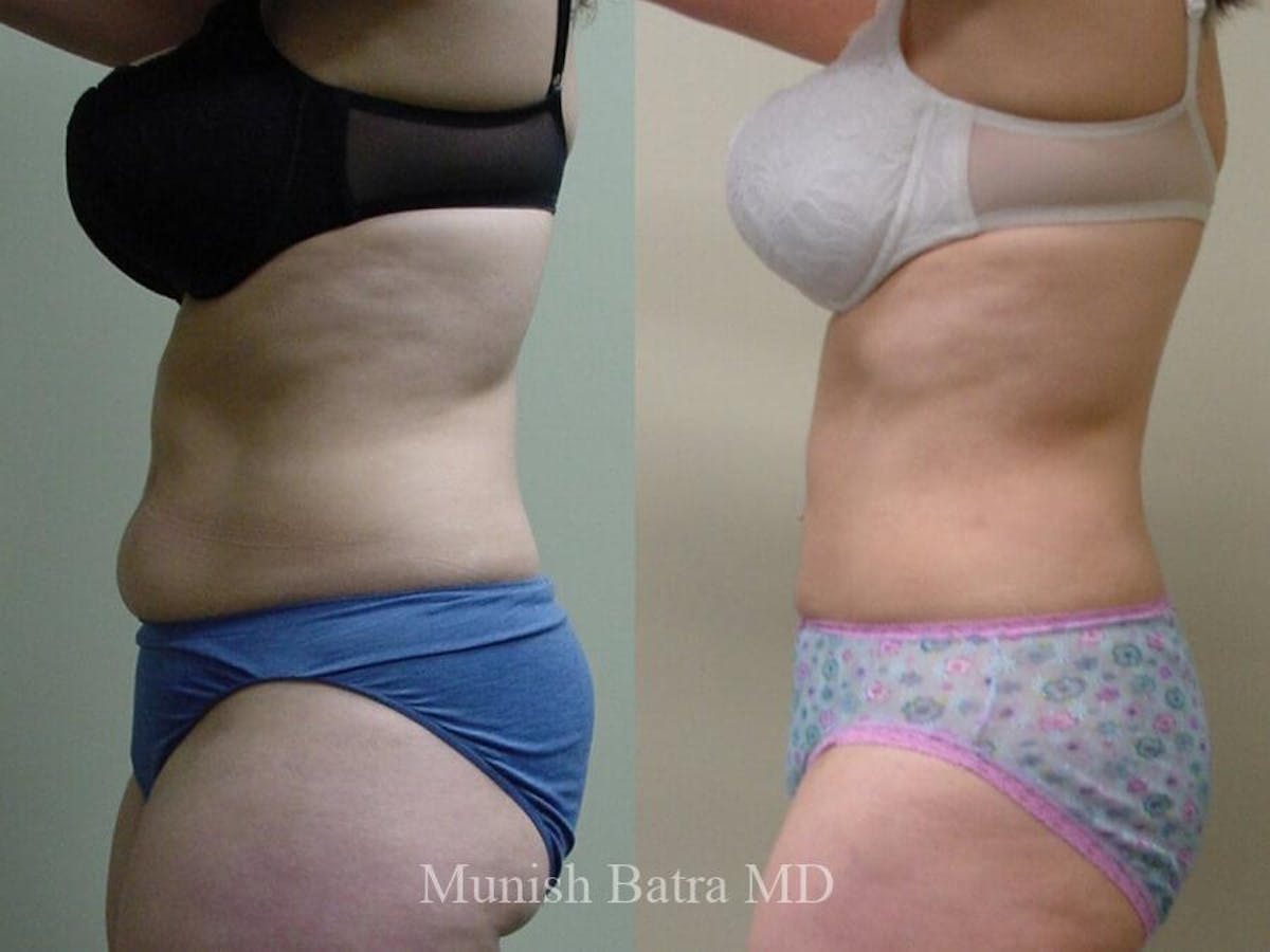 Liposuction & Body Contouring Before & After Gallery - Patient 856799 - Image 1
