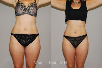 Liposuction & Body Contouring Before & After Gallery - Patient 342611 - Image 1