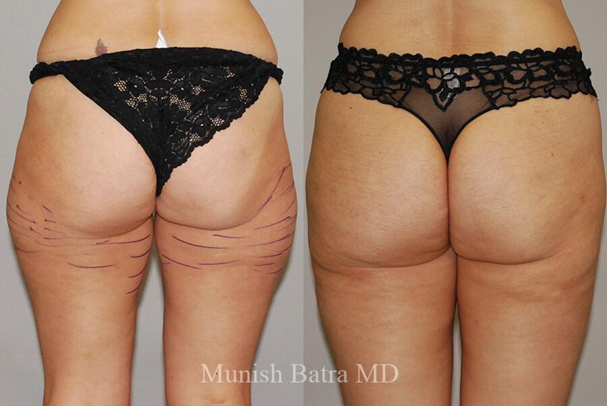 Liposuction & Body Contouring Before & After Gallery - Patient 342611 - Image 2