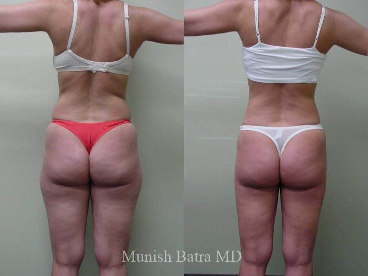 Liposuction & Body Contouring Before & After Gallery - Patient 172924 - Image 1