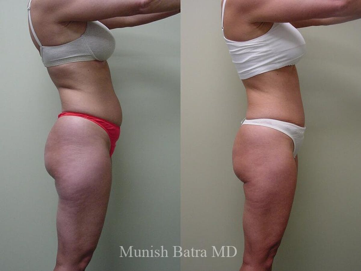 Liposuction & Body Contouring Before & After Gallery - Patient 172924 - Image 2