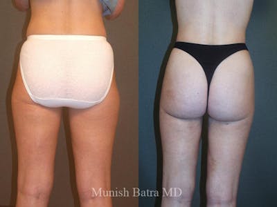 Liposuction & Body Contouring Before & After Gallery - Patient 265966 - Image 1