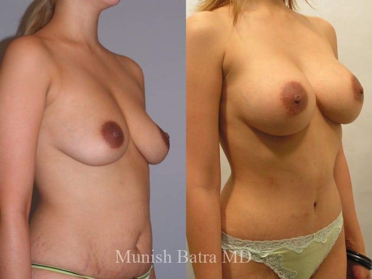 Mommy Makeover Before & After Gallery - Patient 327177 - Image 2