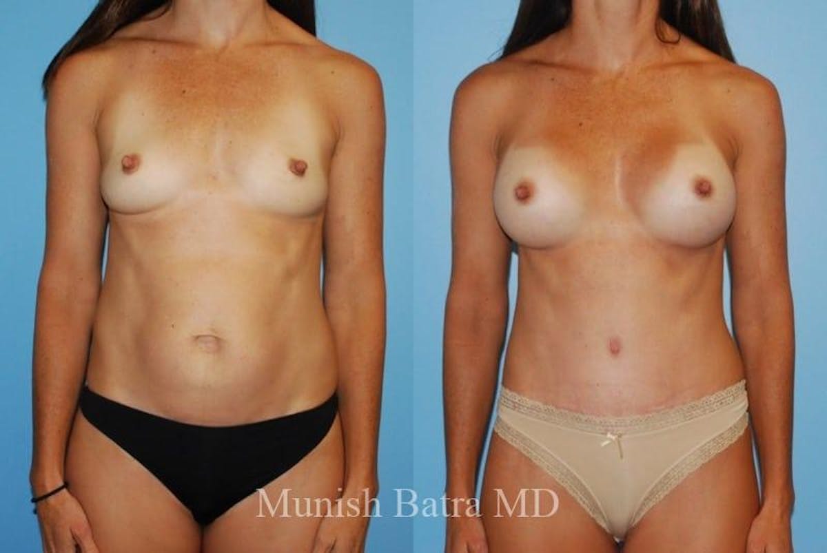 Mommy Makeover Before & After Gallery - Patient 172899 - Image 1
