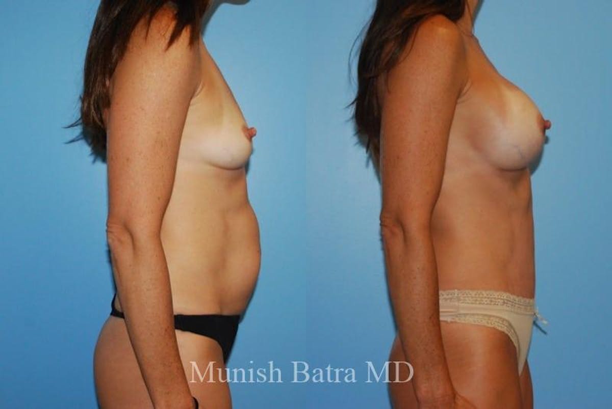 Mommy Makeover Before & After Gallery - Patient 172899 - Image 2
