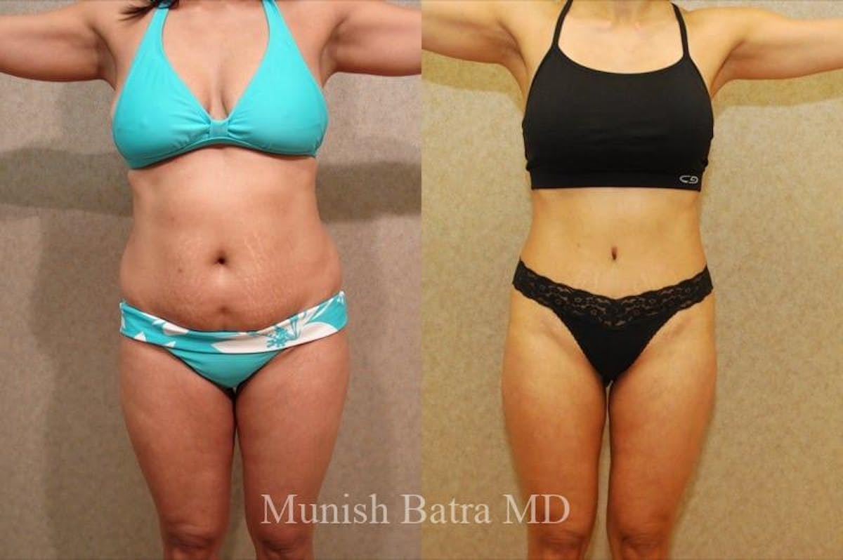 Mommy Makeover Before & After Gallery - Patient 793271 - Image 1