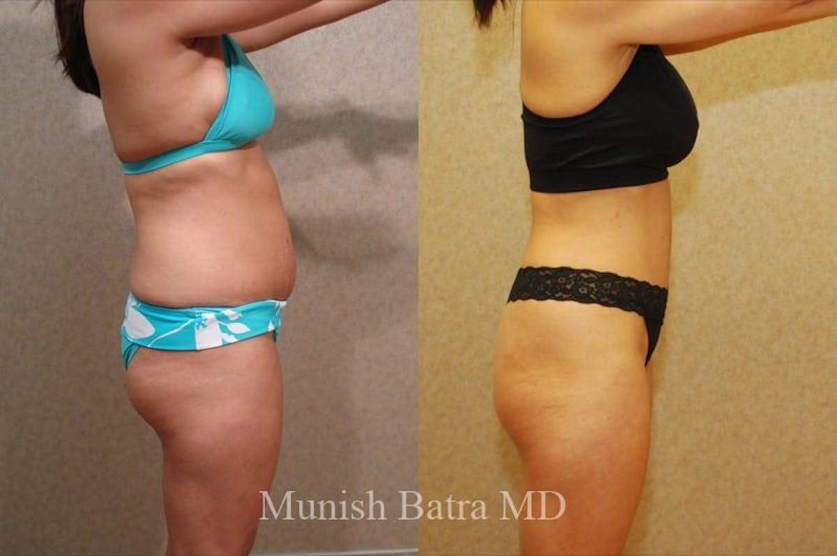 Mommy Makeover Before & After Gallery - Patient 793271 - Image 2