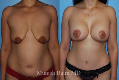 Breast Augmentation with Lift Mastopexy Before & After Gallery - Patient 352080 - Image 1
