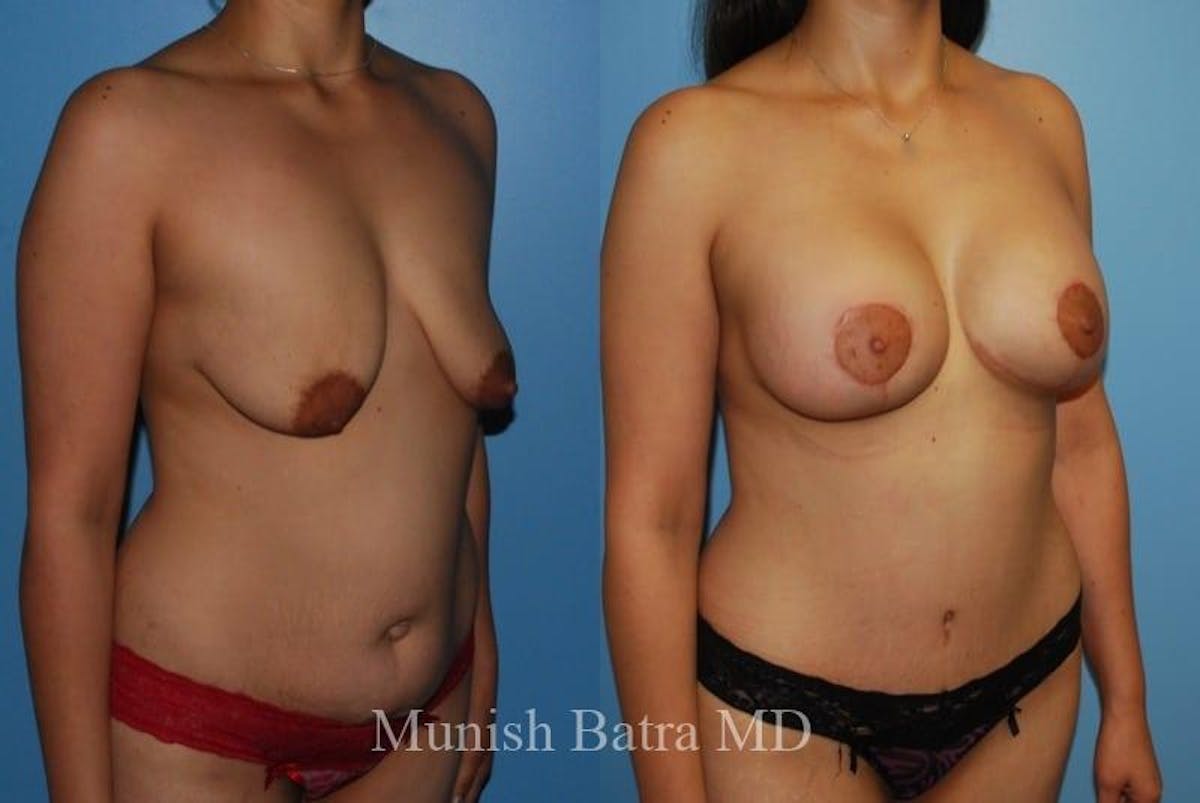 Mommy Makeover Before & After Gallery - Patient 291289 - Image 2