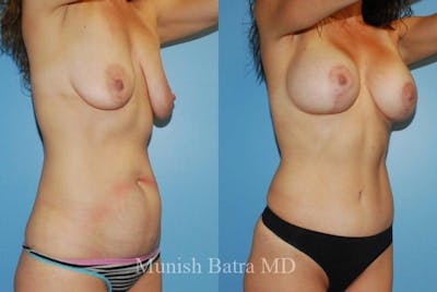 Mommy Makeover Before & After Gallery - Patient 228806 - Image 1