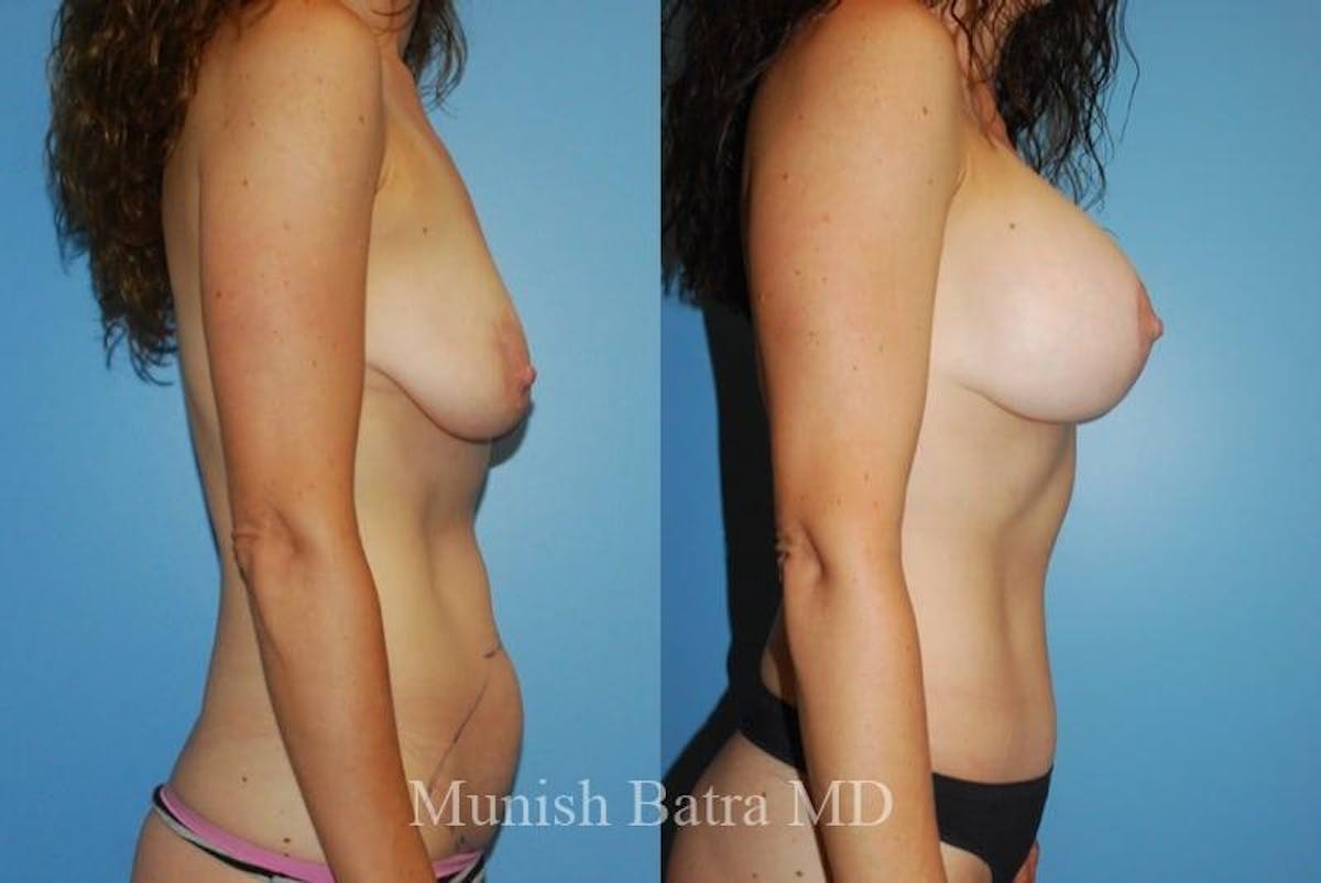 Mommy Makeover Before & After Gallery - Patient 403528 - Image 2