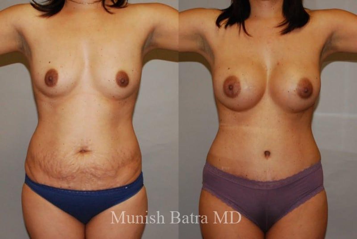 Mommy Makeover Before & After Gallery - Patient 571549 - Image 1