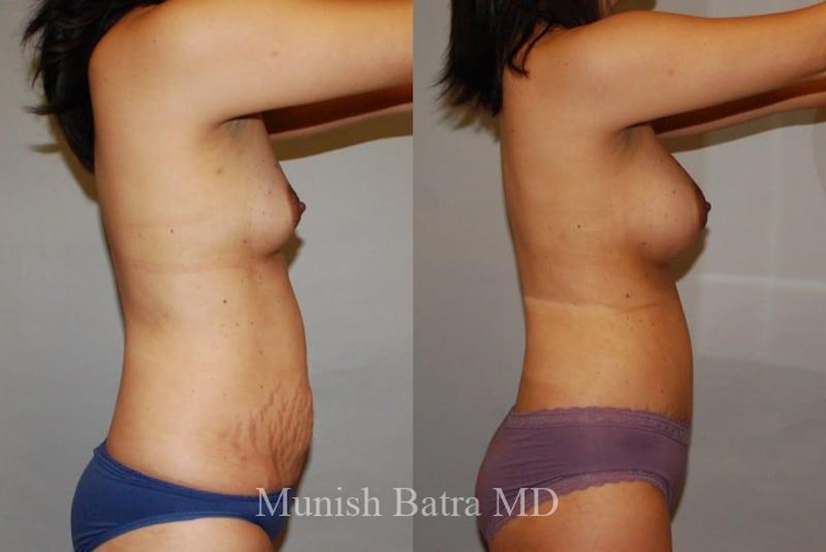 Mommy Makeover Before & After Gallery - Patient 571549 - Image 2